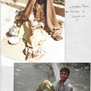 1996 Leprosy 01